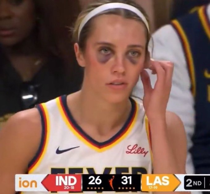 強度趕上CBA！??WNBA狂熱前鋒赫爾被“打成熊貓”了